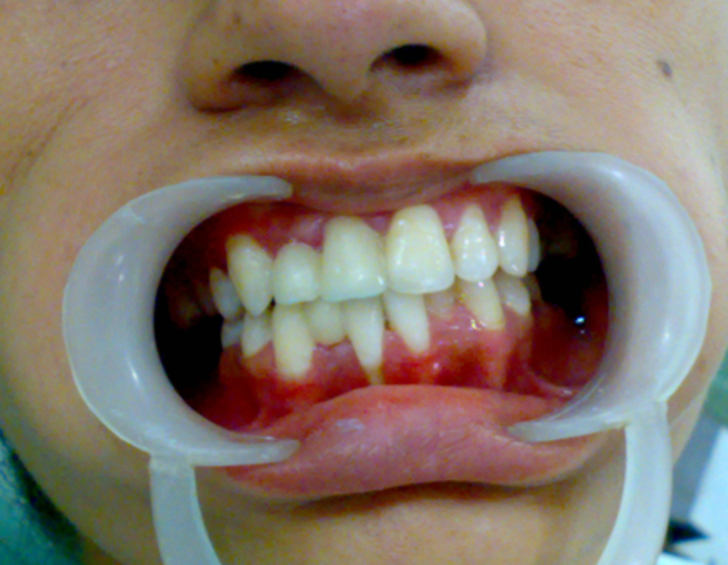 After Treatment 2